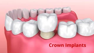 Empire Dental Care | Crown Implants in Webster, NY