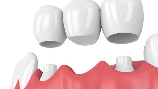 Empire Dental Care : Bridges in Webster, NY