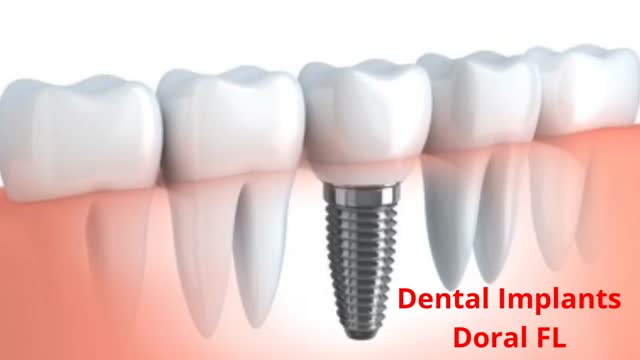 Miami Dental Group - Best Dental Implants in Doral, FL