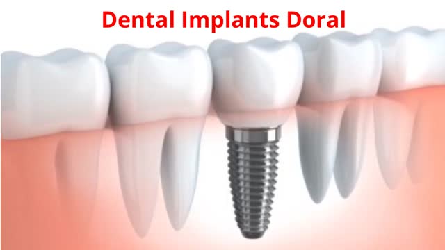 Miami Dental Group - #1 Dental Implants in Doral, FL