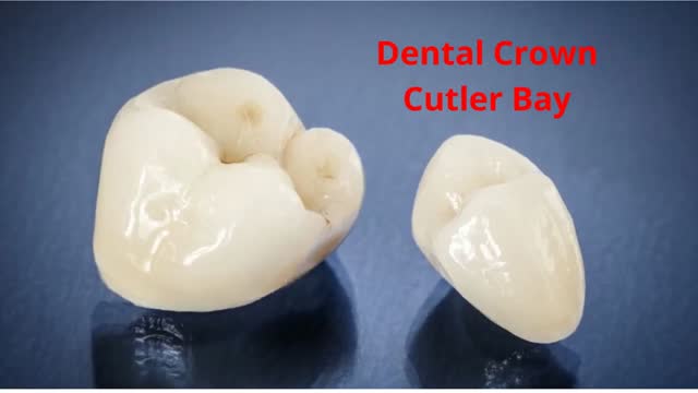 Dr. Lysette González Dental Clinic : Dental Crown in Cutler Bay, FL