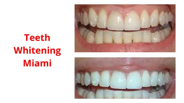 Florida Dental Care of Miller : #1 Root Canal in Miami