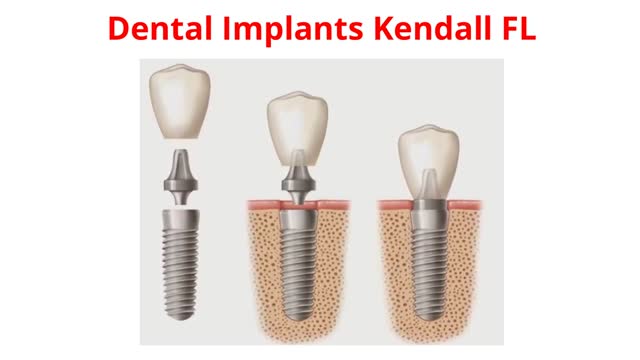 Miami Dental Group - Best Dental Implants in Kendall, FL