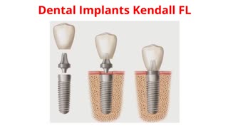 Miami Dental Group - Best Dental Implants in Kendall, FL