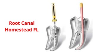 Smile Plus Homestead : Root Canal in Homestead, FL | 33030