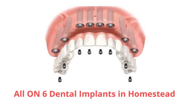 Smile Plus : All ON 6 Dental Implants in Homestead, FL