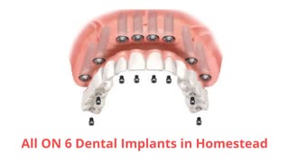 Smile Plus : All ON 6 Dental Implants in Homestead, FL