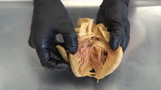 You Can Literally Die From a Broken Heart | Broken Heart Syndrome