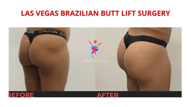 Premier Liposuction : BBL in Las Vegas, NV