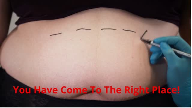 Premier Liposuction - #1 Lipo in Las Vegas, NV