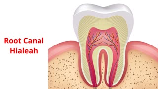 Paya Dental - Root Canal in Hialeah, FL